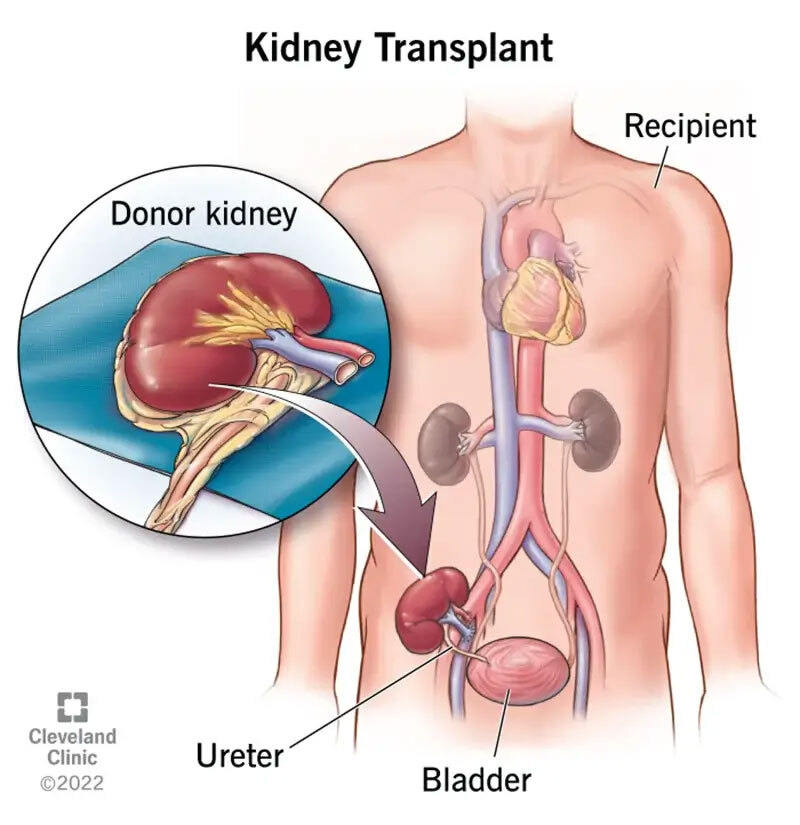 Kidney Transplant Diagram