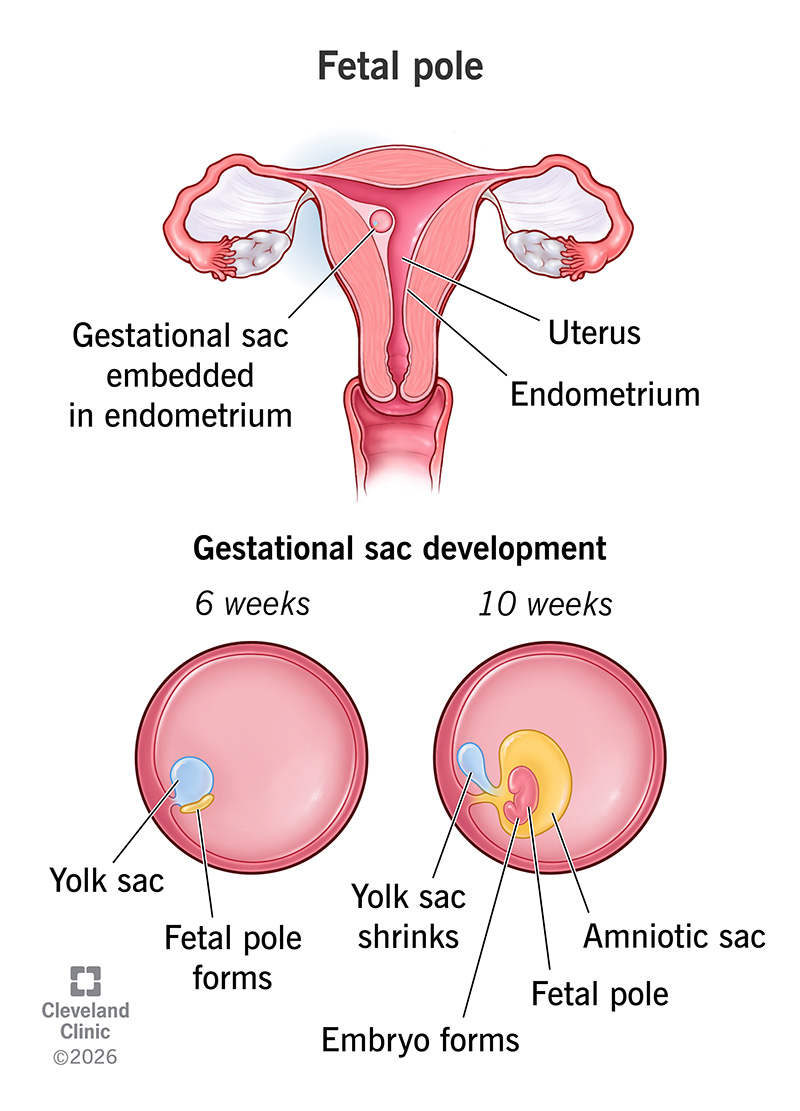 Gestational sac at 6 and 10 weeks showing the yolk sac, fetal pole and amniotic sac