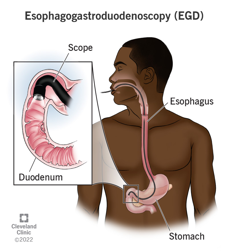 An esophagogastroduodenoscopy passes a lighted scope down your throat into your stomach and intestines.