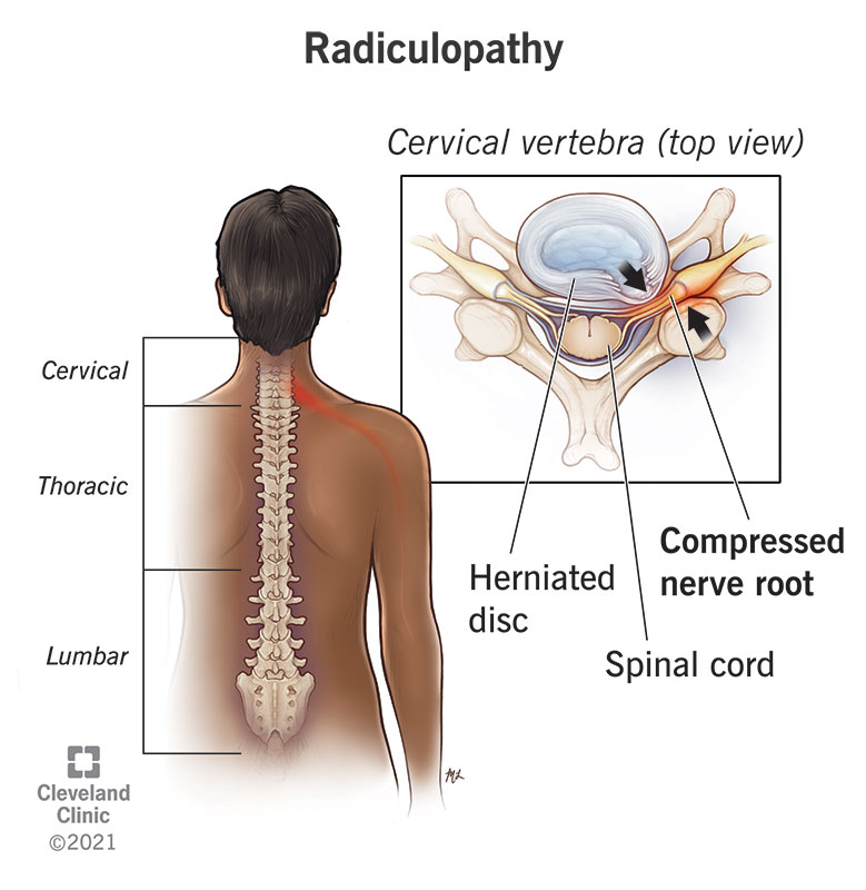 Radiculopathy in a cervical vertebra
