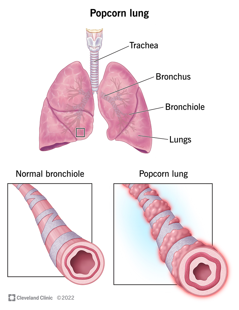 The bronchioles of your lungs are inflamed, scarred and damaged you have bronchiolitis obliterans, also called popcorn lung.