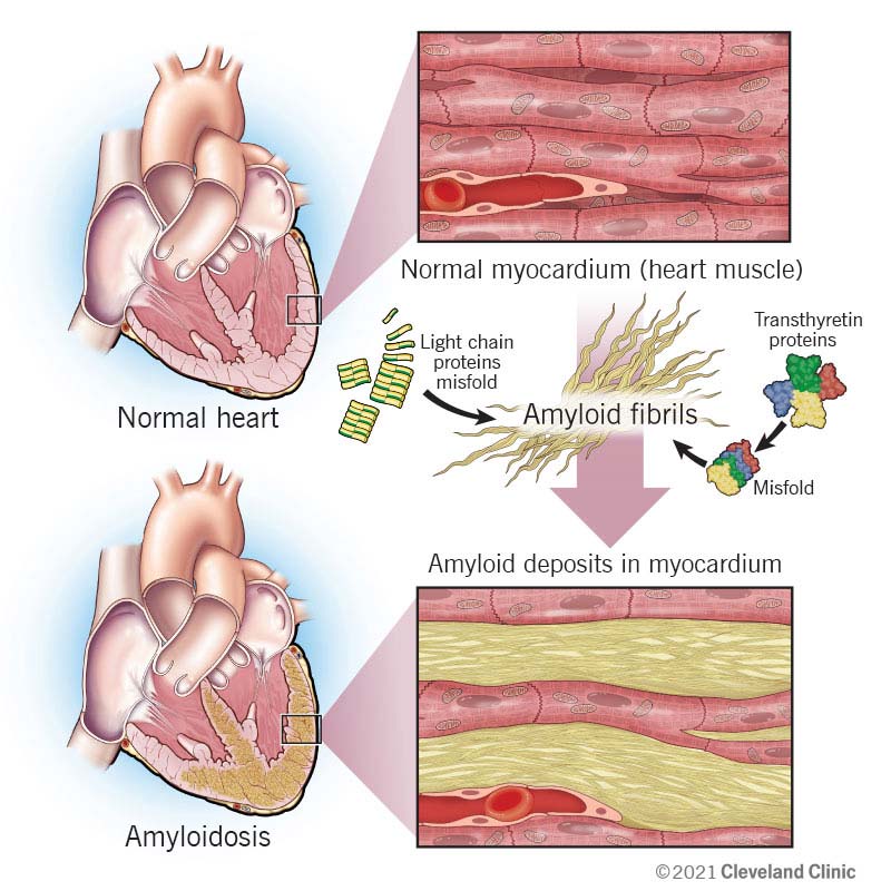 How amyloid protein fibrils accumulate and disrupt heart muscle function.