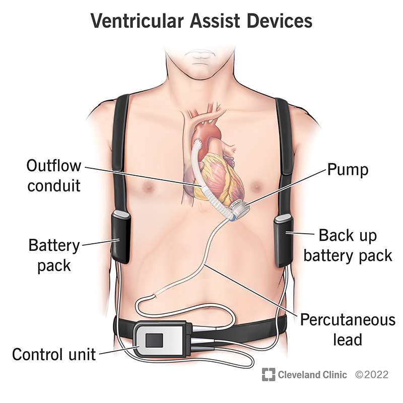 The components (pieces) of ventricular assist devices (VADs).