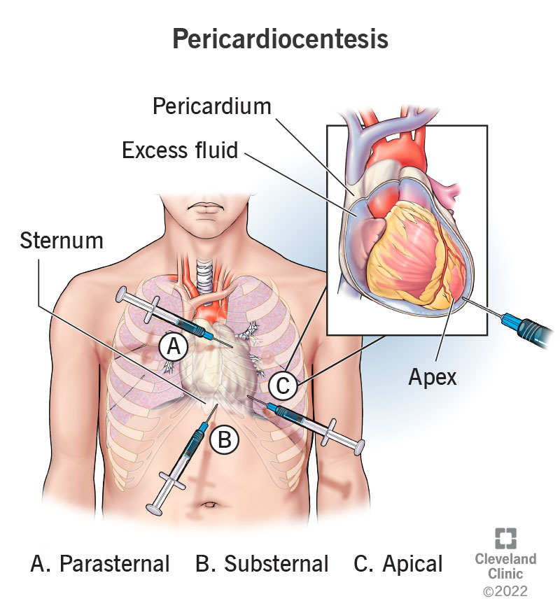 cardiac tamponade symptoms