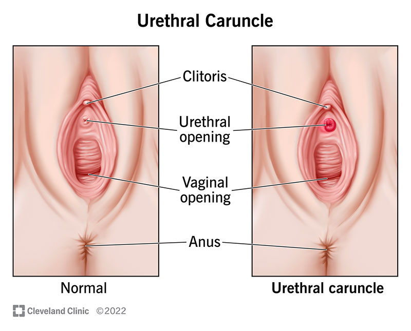 Typical urethral opening vs. urethral caruncle.