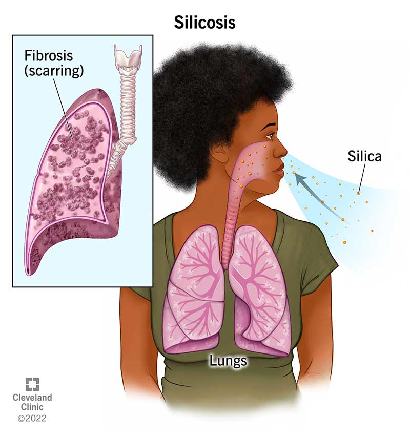 Inhaling silica (silicon dioxide) particles leads to scarring (fibrosis) in the lungs of people with silicosis.