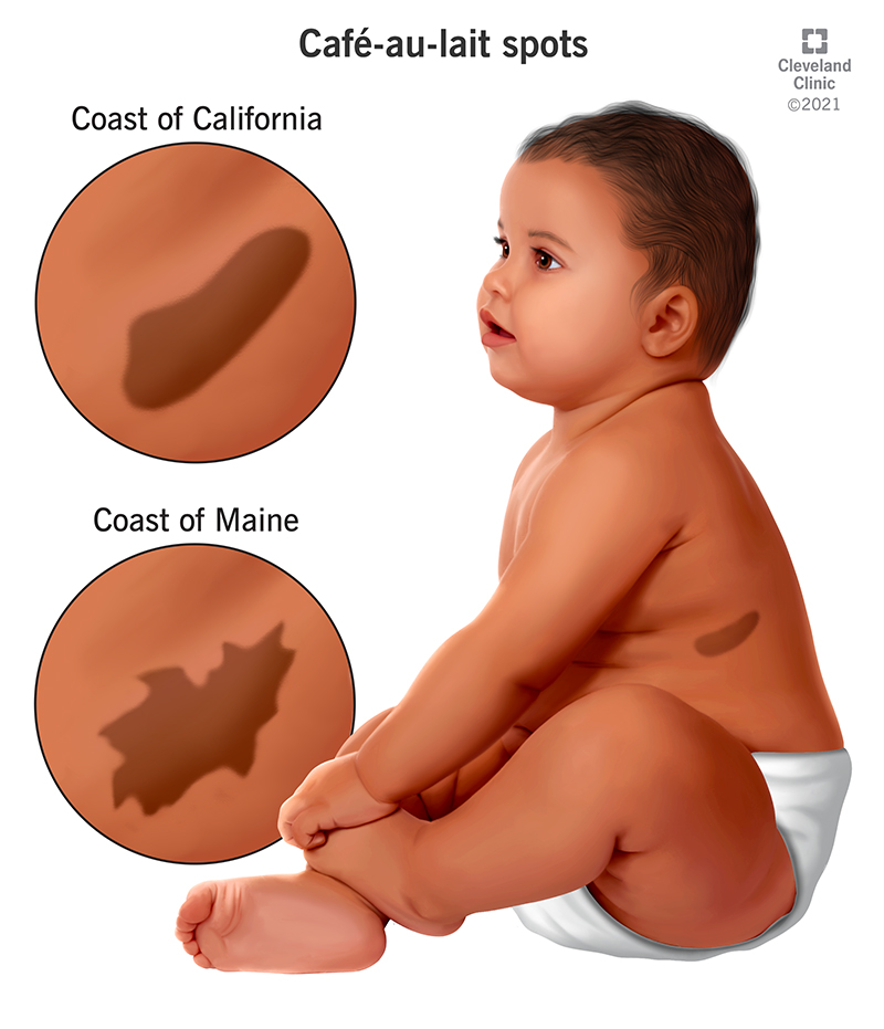 caf-au-lait-spots
