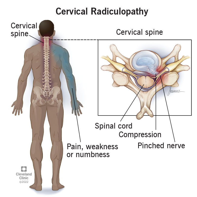 Cervical radiculopathy, or "pinched nerve," happens when compression and inflammation of any of the nerve roots in your neck cause radiating pain, muscle weakness and/or numbness down your arm.