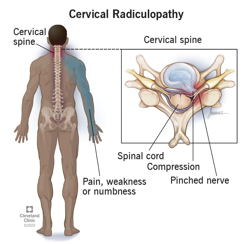 Cervical Radiculopathy (Pinched Nerve in Neck): Symptoms & Treatment