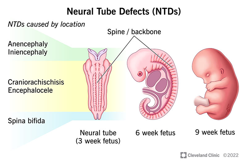Medical drawing of the neural tube in a 3- and 6-week fetus as well as a 9-week fetus.