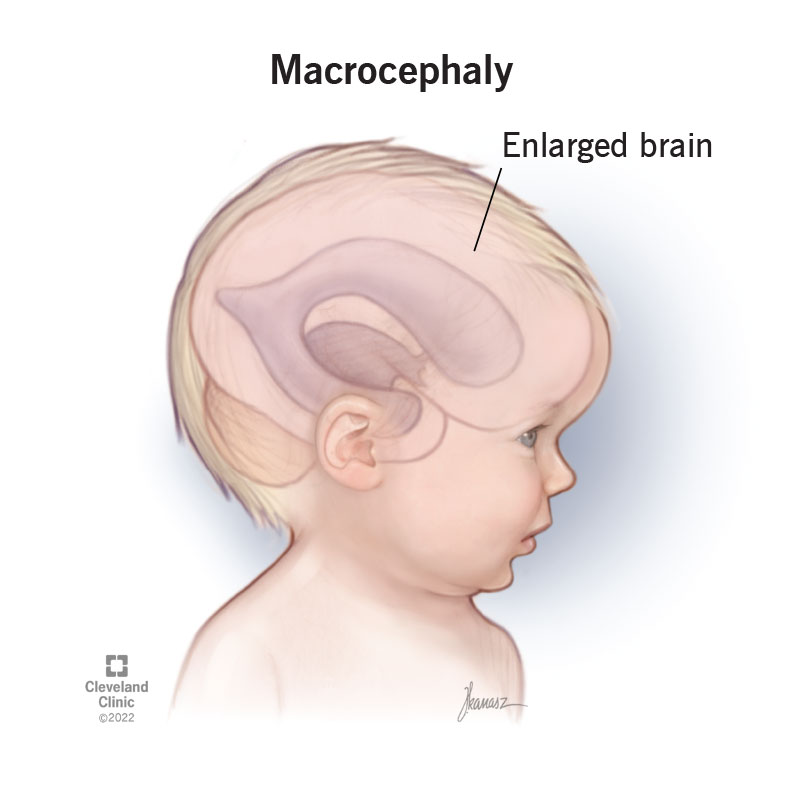Baby with macrocephaly and an enlarged brain.