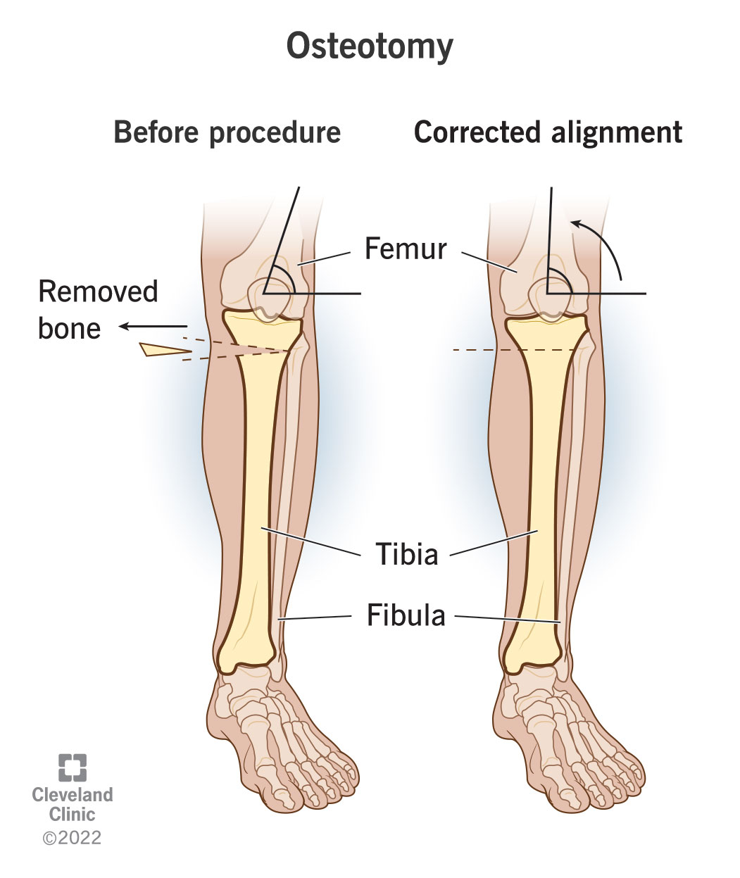 Before and after osteotomy to reshape or realign bone.