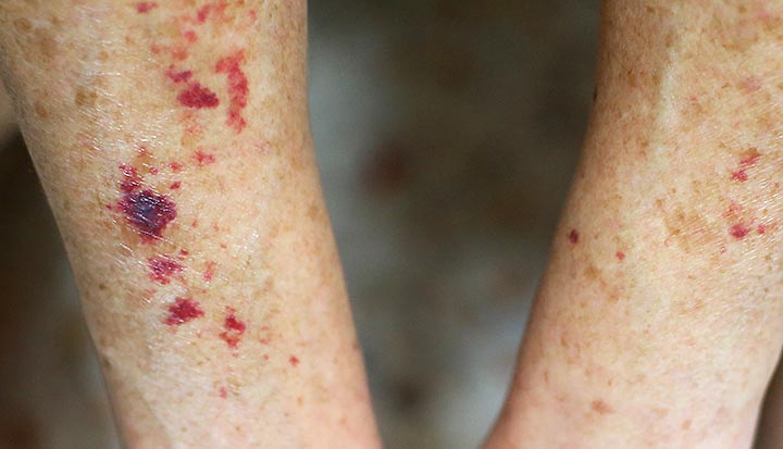 Purpura on a person’s arms are red, purple and brown spots on their skin.