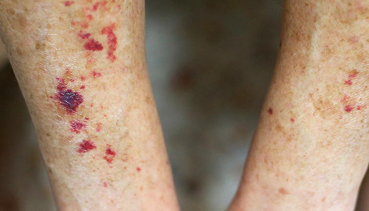 cluster-of-red-spots-on-foot-store-emergencydentistry