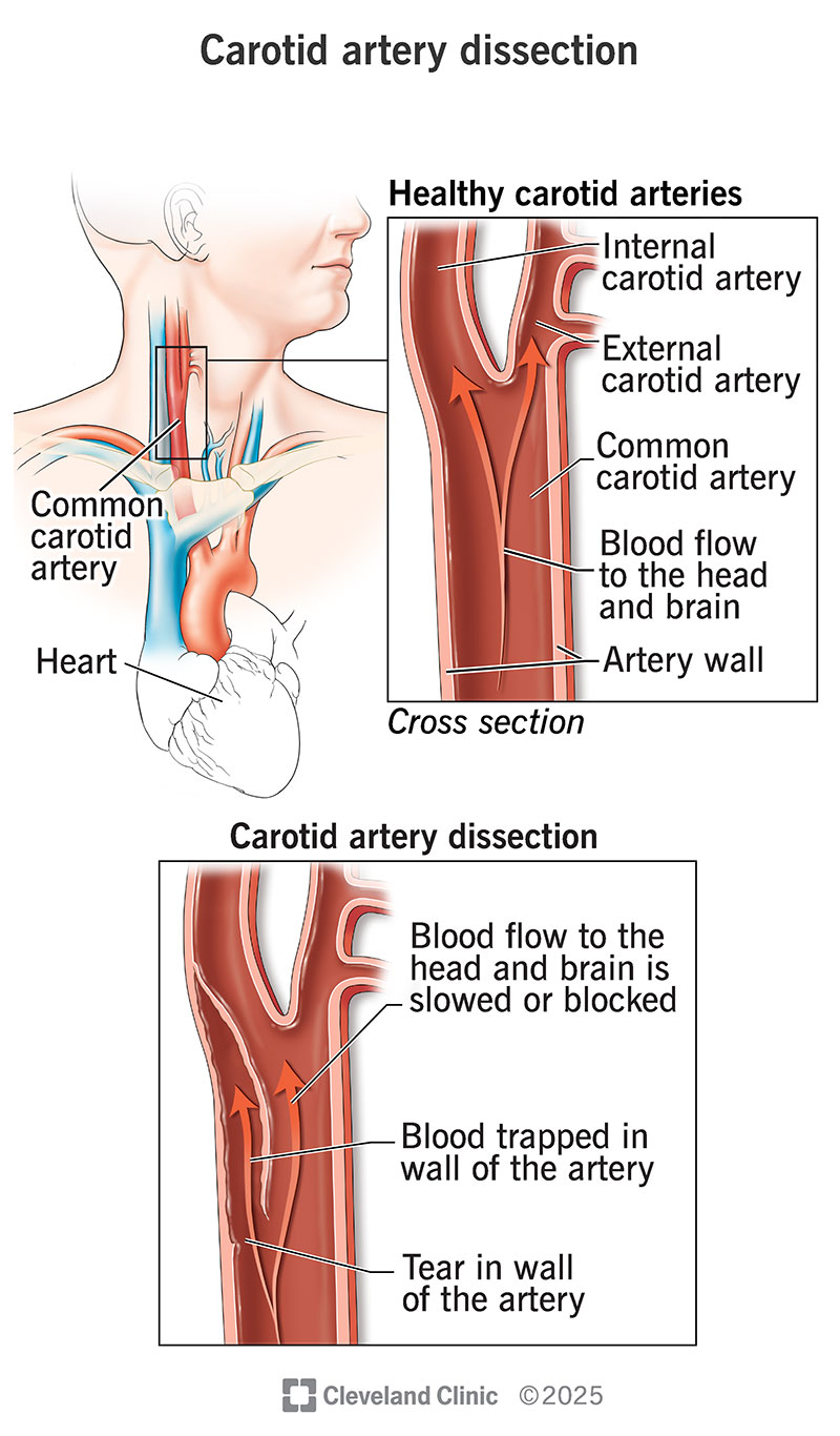 A carotid artery dissection (tear) traps blood in your artery wall, slowing or blocking blood flow to your brain