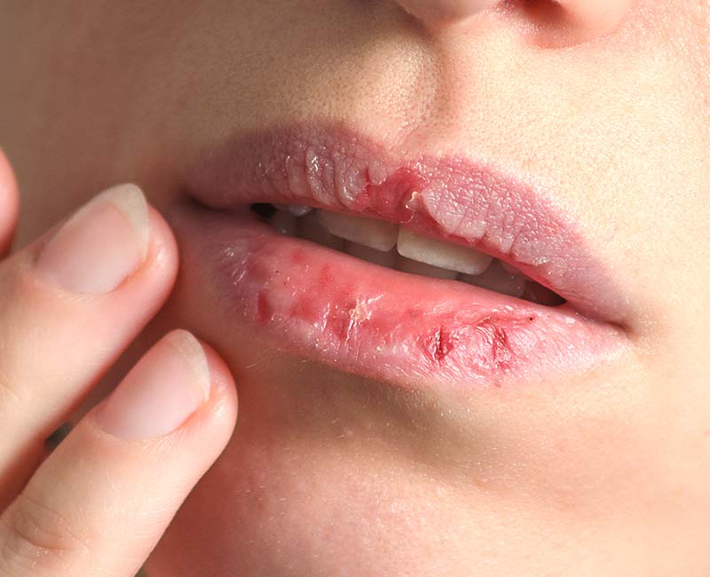 Peeling, damaged skin on the lips can happen with dermatillomania.