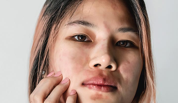 Eczema On Lips Lip Dermatitis Triggers 