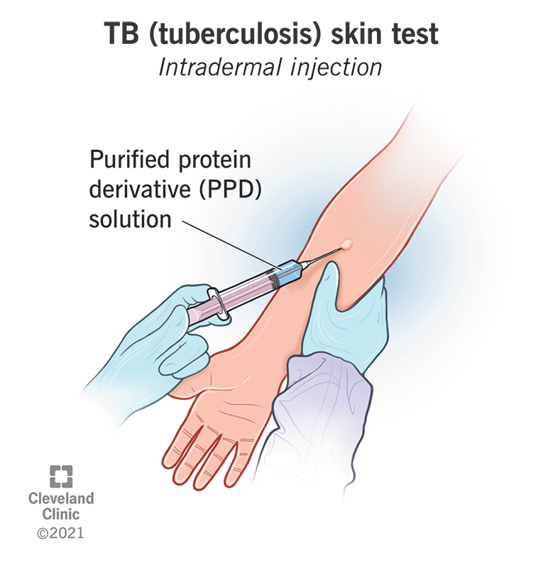 sangtekster bryder daggry faldt TB (Tuberculosis) Test: Purpose, Procedure & Results