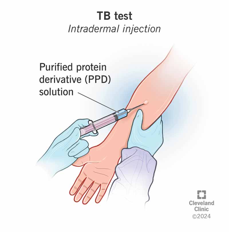 positive mantoux skin test