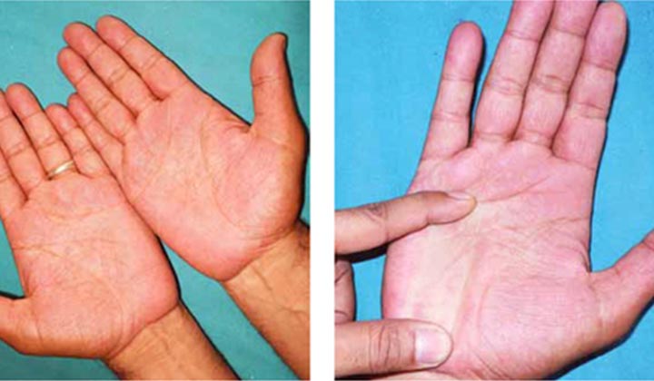Skin redness on hands with erythromelalgia.