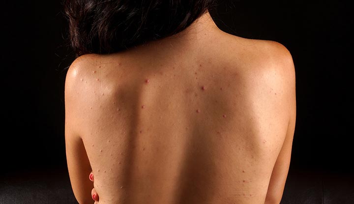 Back acne (also known as “bacne”) is acne on your back and shoulders.
