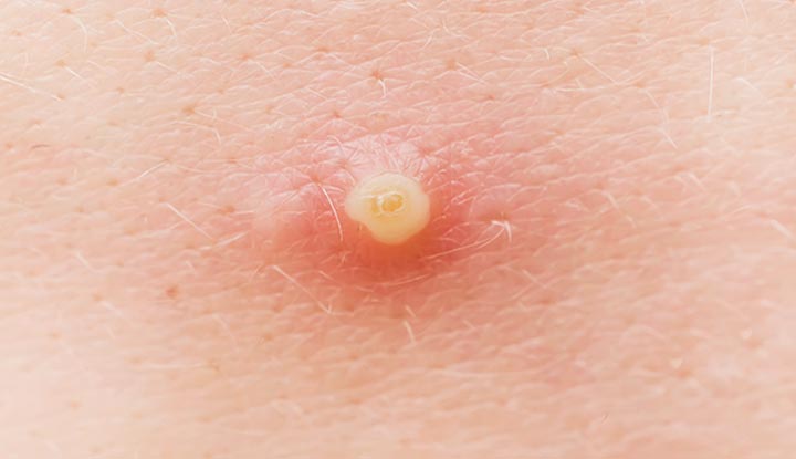 An infected pimple on a person’s skin.