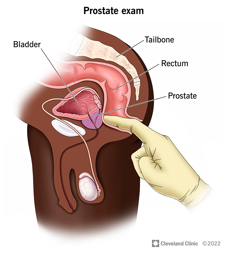 Healthcare provider performing DRE portion of prostate exam by inserting gloved finger into rectum