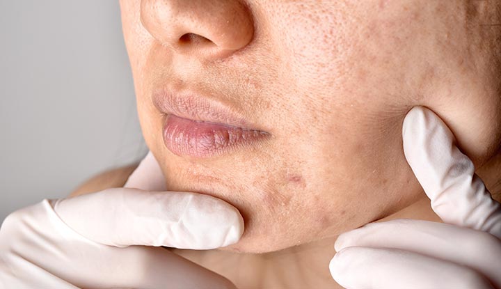 Clogged pores caused blackheads and pimples on woman's face.