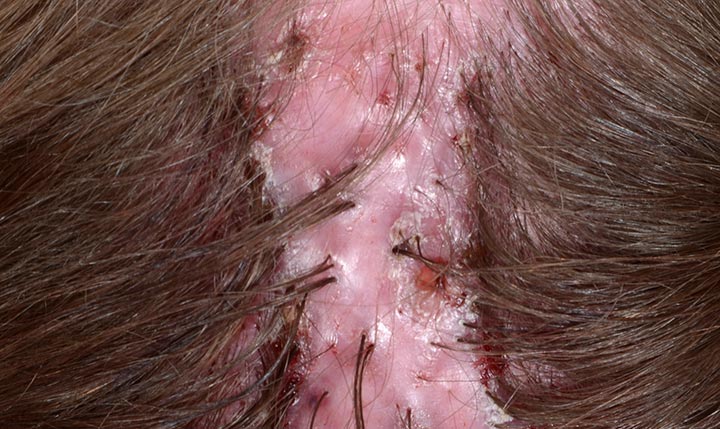 folliculitis hair loss