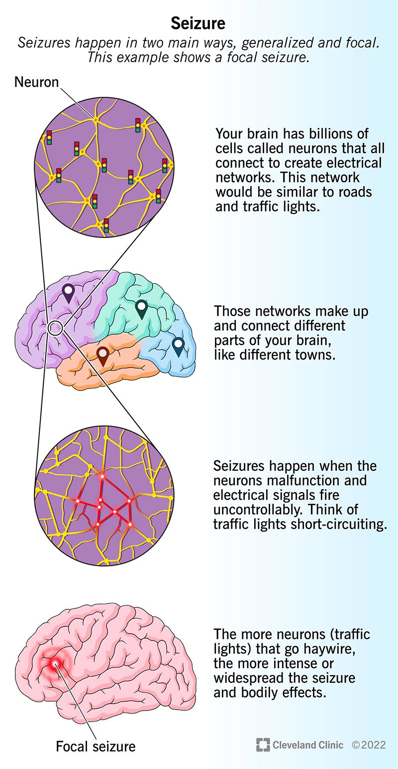 Neural networks in your brain transmit signals. Seizures disrupt this electrical flow.