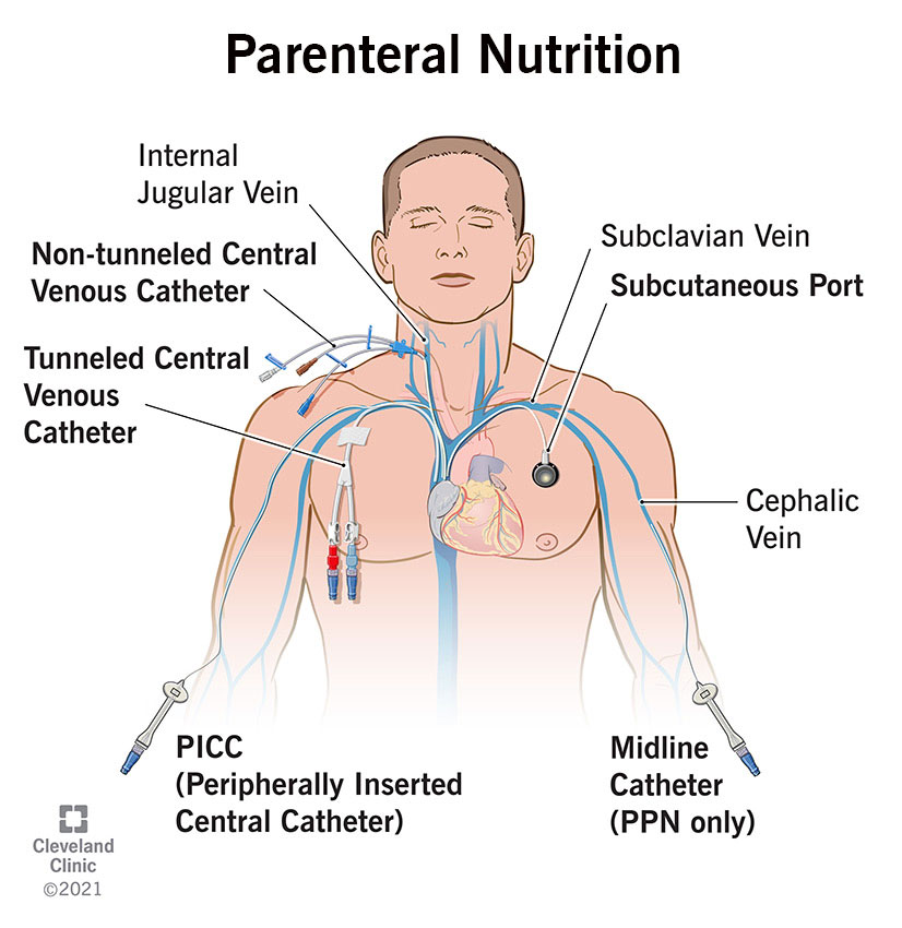 Parenteral Nutrition Illustration