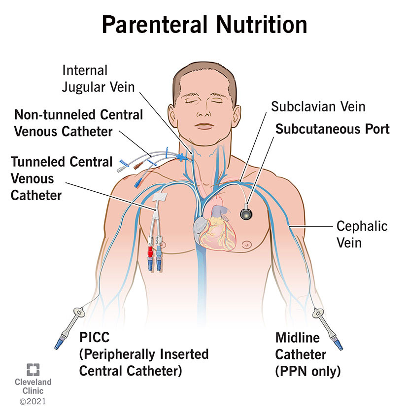 How Much Is Total Parenteral Nutrition