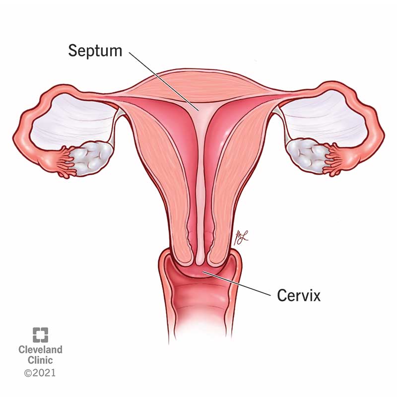 Cross section of a septate uterus. It shows a septum (membrane) separating the uterus in to two halves.