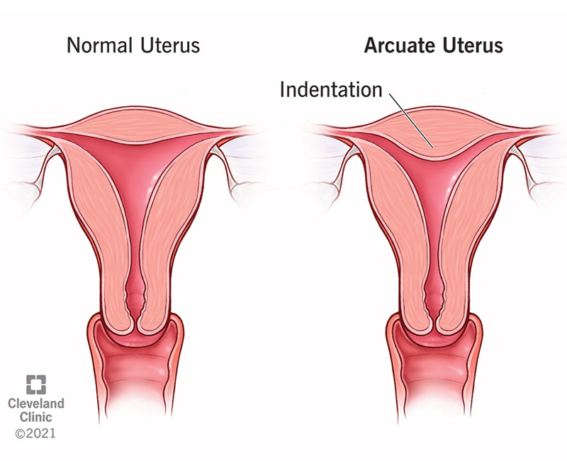 Normal uterus vs arcuate uterus. The arcuate uterus has an indentation at the top.