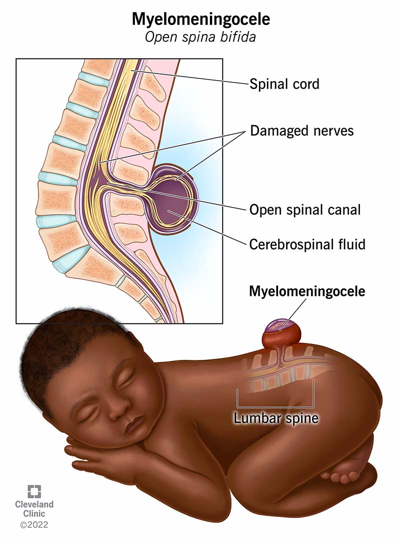 Myelomeningocele results in a sac that protrudes from a baby’s back. It contains part of their spinal cord, nerves and cerebrospinal fluid.