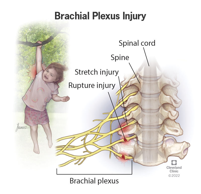 Illustration of a child hanging from a branch with one arm and a closeup of a ruptured and stretched nerve injury in the brachial plexus.