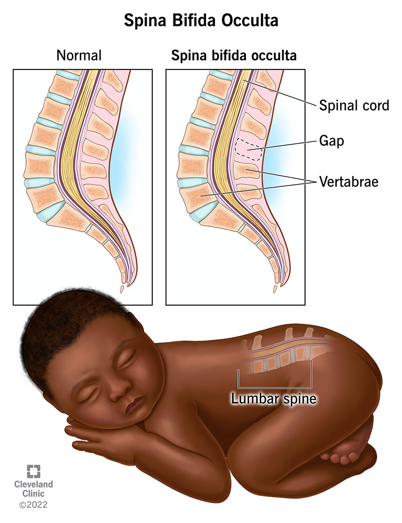 A baby with spina bifida occulta has a gap between the vertebrae of their lumbar spine, which is in the lower part of their back.