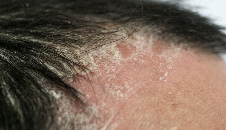 Plaques and flaking skin associated with scalp psoriasis along the hairline and forehead.