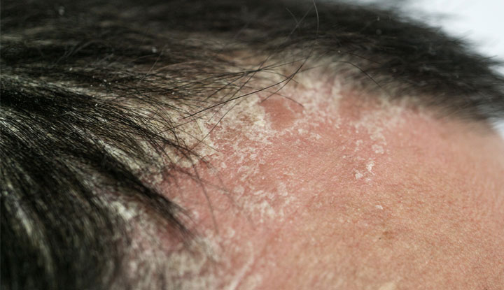 Scalp Psoriasis Symptoms Plaque Causes And Treatment