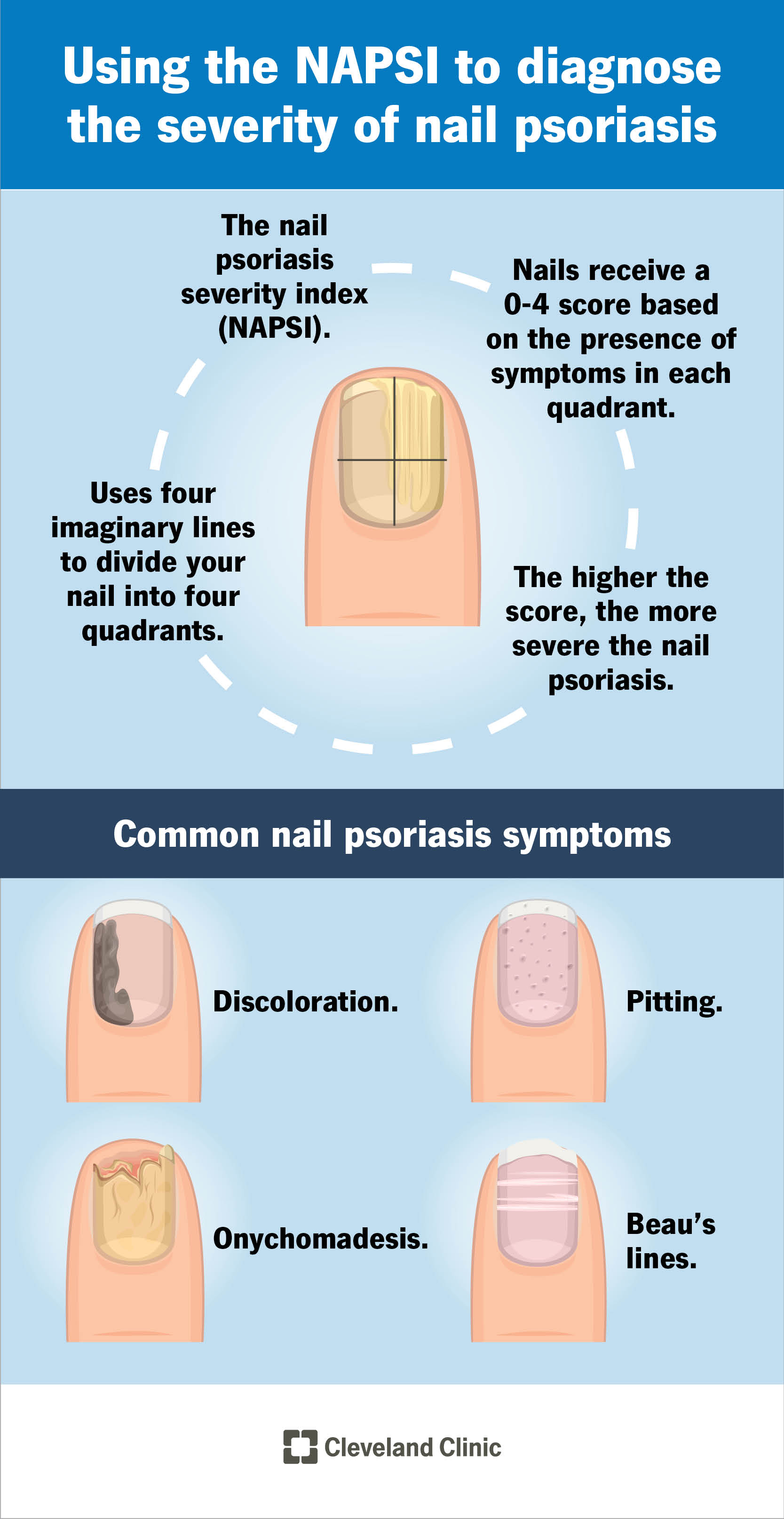 Infographic explaining how the NAPSI index is used to diagnose the severity of nail psoriasis.