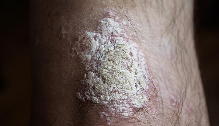 A raised, white plaque associated with plaque psoriasis.