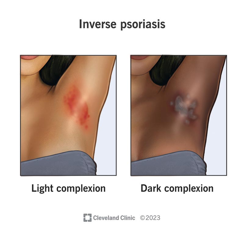 Two depictions of inverse psoriasis in armpits. One is a lighter skin complexion and the other is a darker skin complexion.