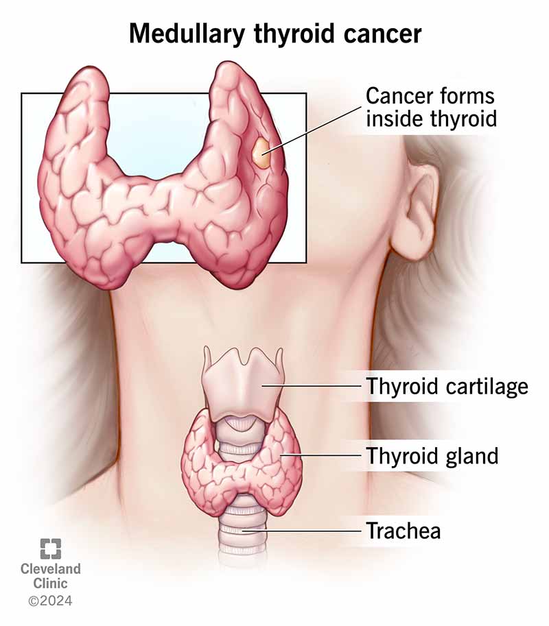 A tumor inside the thyroid gland and the location of the thyroid in the neck