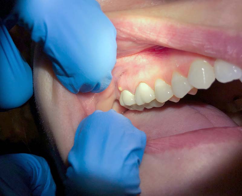 A tooth abscess is a pocket of pus that forms around or near your tooth. It may cause pain and swelling on your gums.