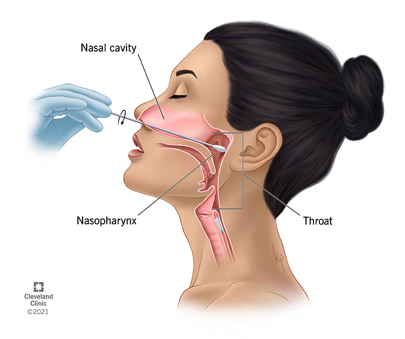 A person tilting their head back to receive a nasopharyngeal swab test in their nose.