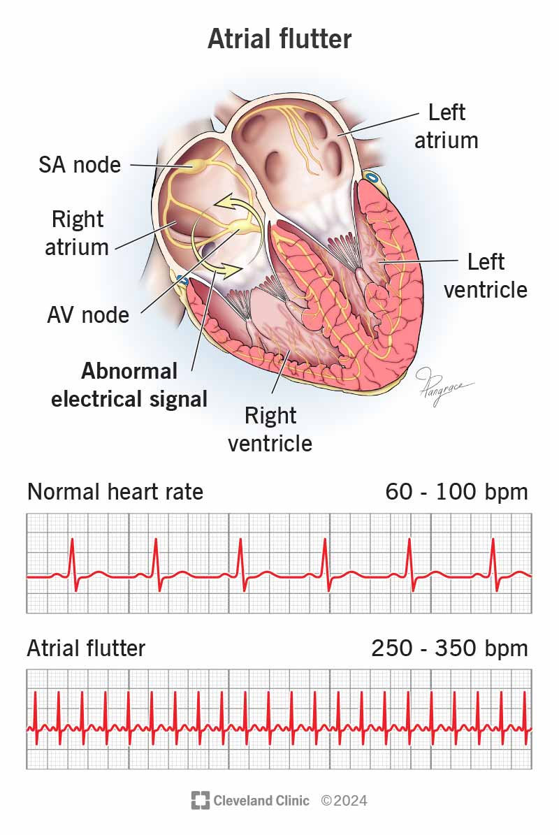 Atrial flutter is a fast heart rhythm that happens because of abnormal electrical signals