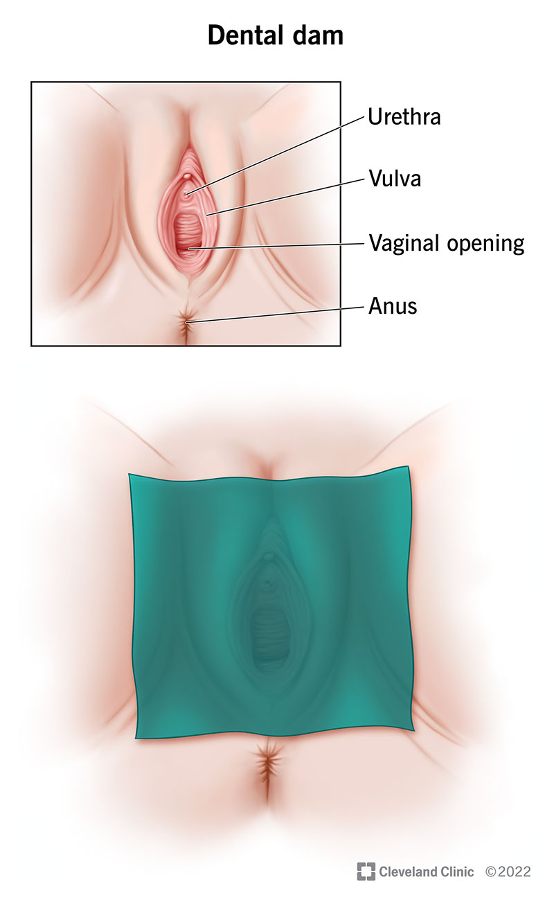 A dental dam is a thin, flexible piece of latex that you place flat over your vulva and vagina to protect you during oral sex.