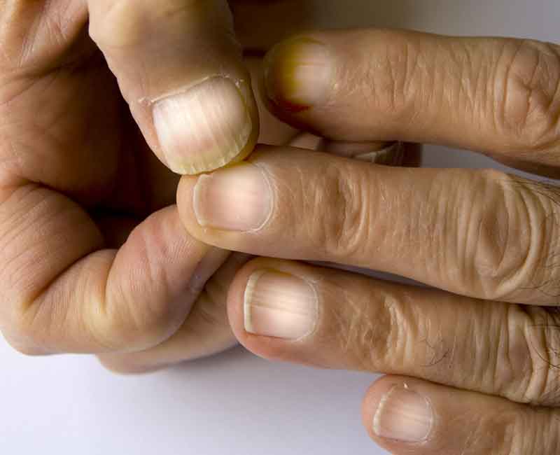 Terry’s nails on this man’s hand look like frosted glass with no half-moon shape near the cuticle and a brown strip near the tip.