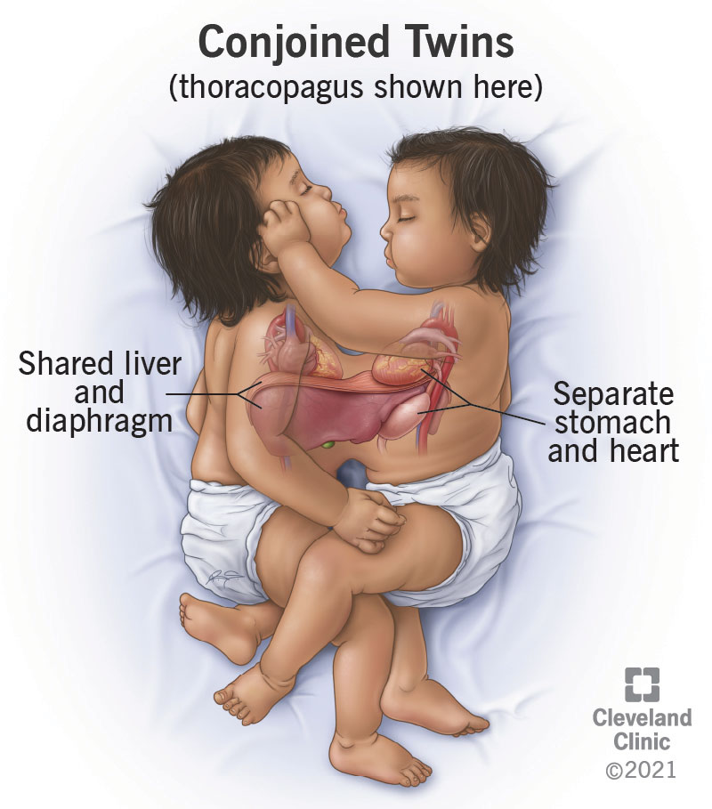 Twin girls joined at the shoulder share a liver and diaphragm.