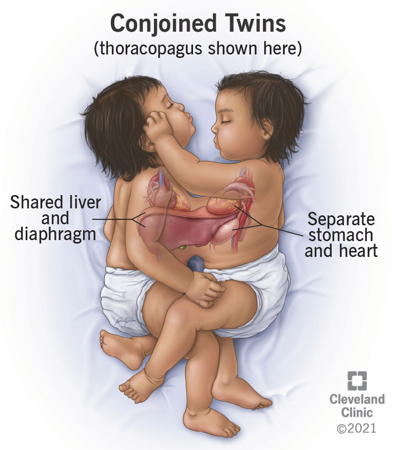 conjoined-twins-definition-causes-outlook